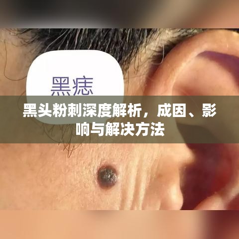 黑头粉刺深度解析，成因、影响与解决方法